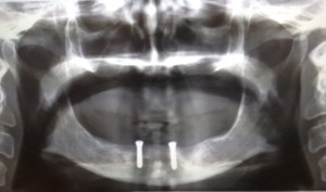 Two dental implants in lower jaw to retain lower denture