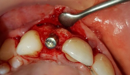 Healing abutment screwed onto dental implant 